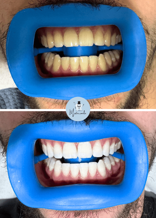 AvAp bannière Transformation avant après chez Mister Smile